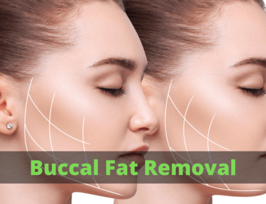 Buccal fat removal